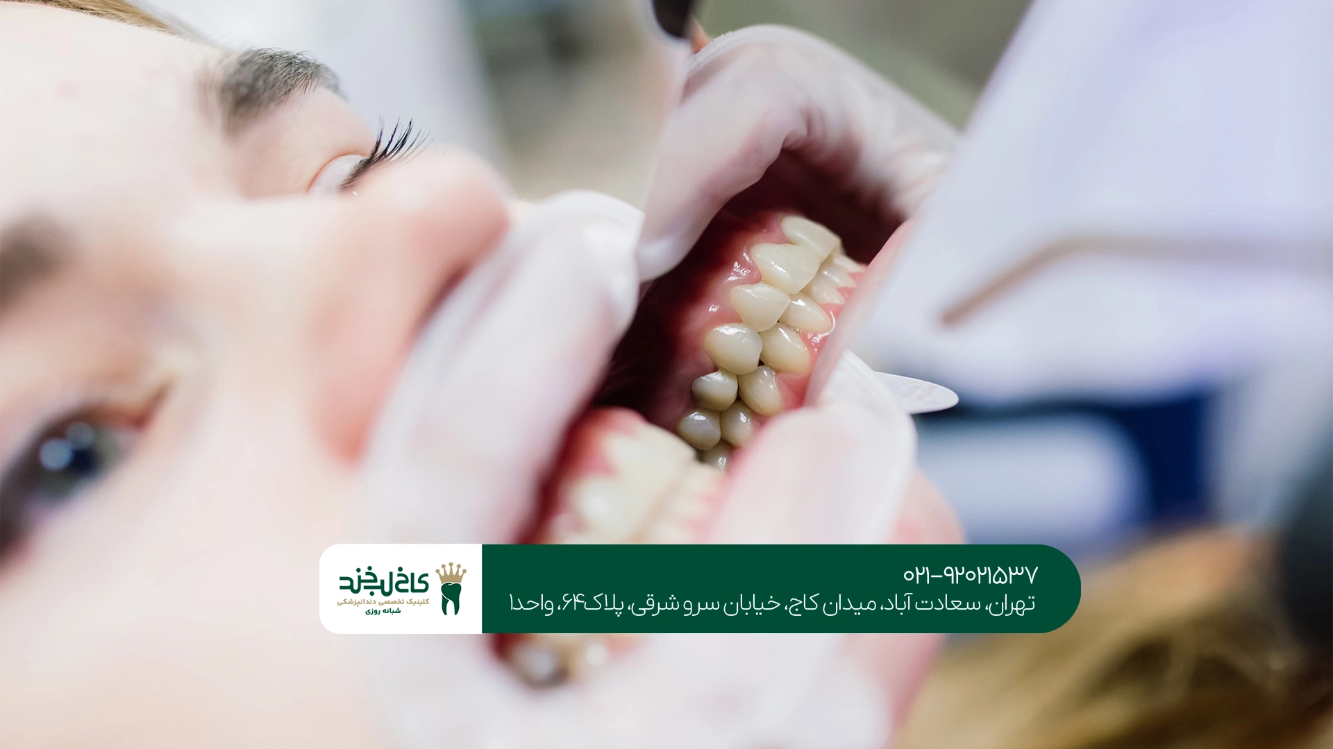 مراحل انجام کامپوزیت دندانهای کوچک چگونه است؟