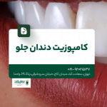 کامپوزیت دندان جلو