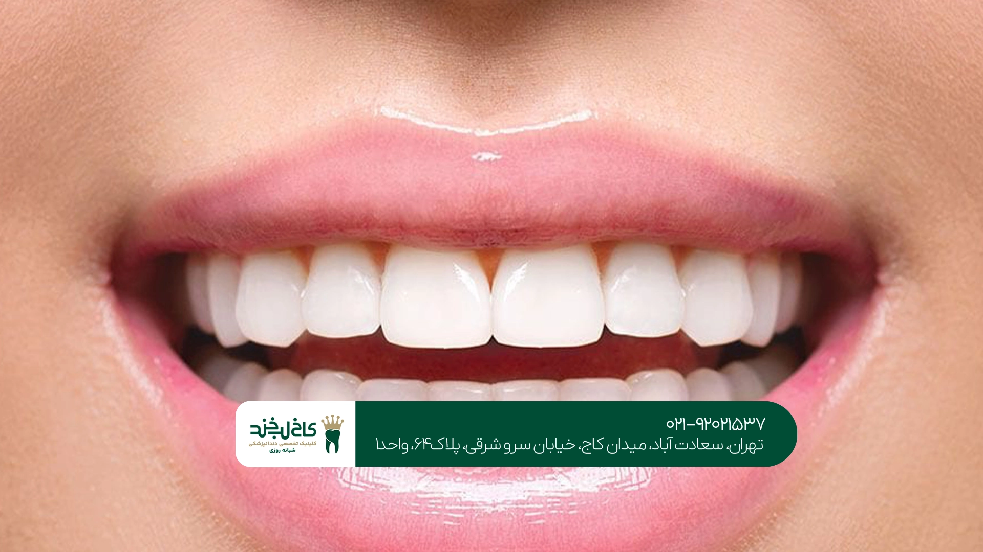 کامپوزیت دندان جلو