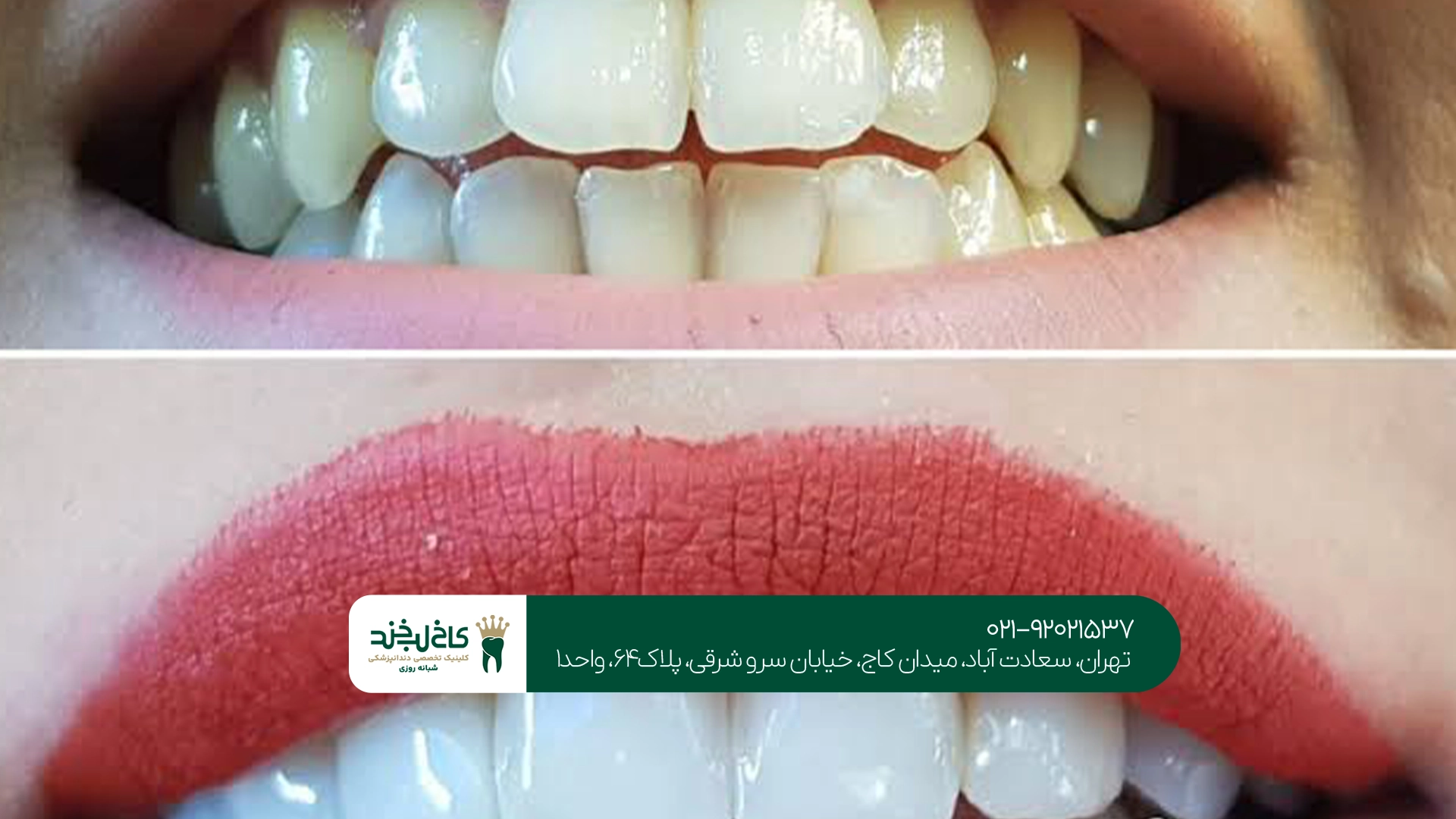 کلینیک تخصصی کامپوزیت دندان خرگوشی کلینیک تخصصی کامپوزیت دندان خرگوشی