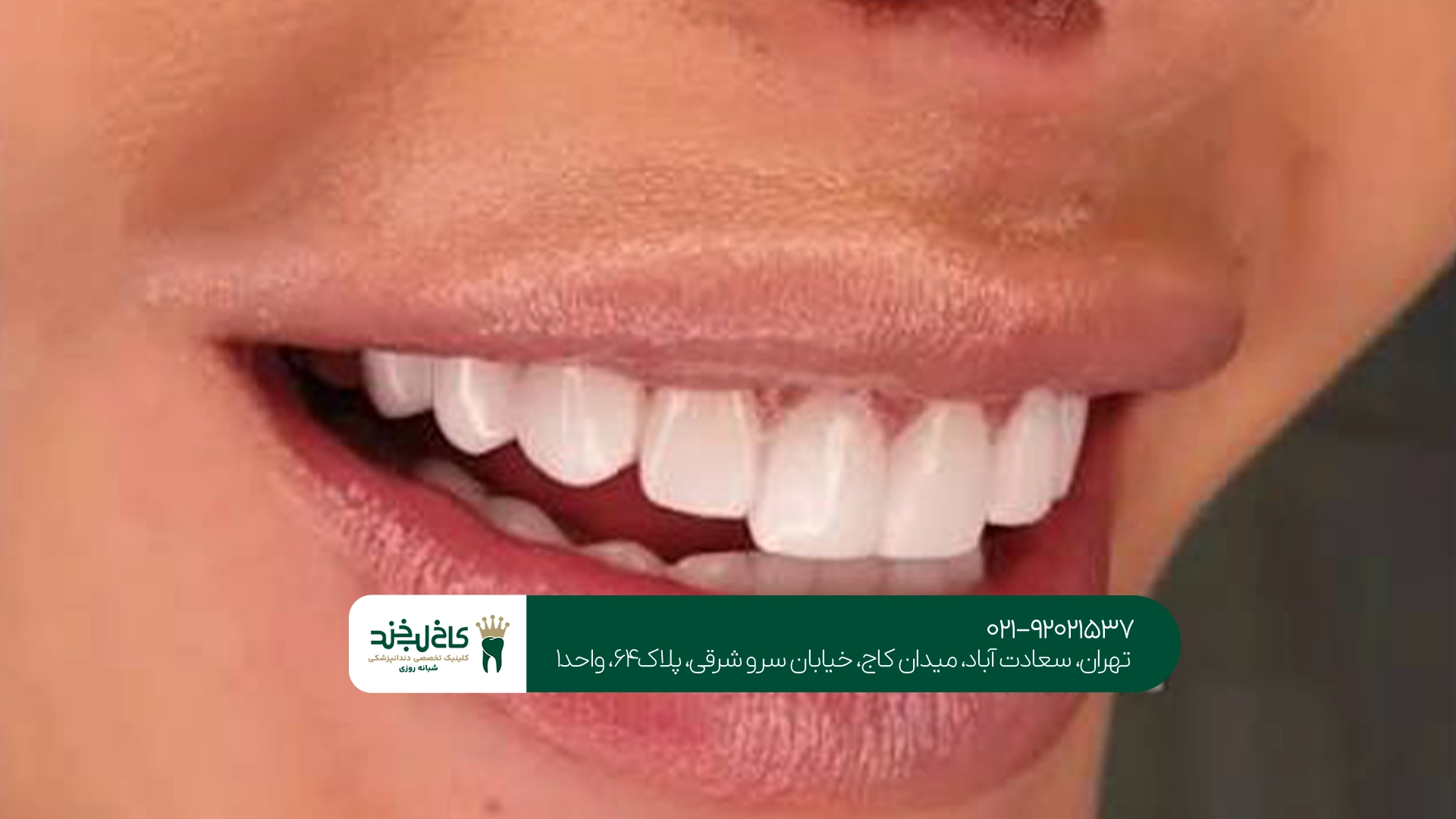 کامپوزیت دندان خرگوشی در تهران کامپوزیت دندان خرگوشی در تهران