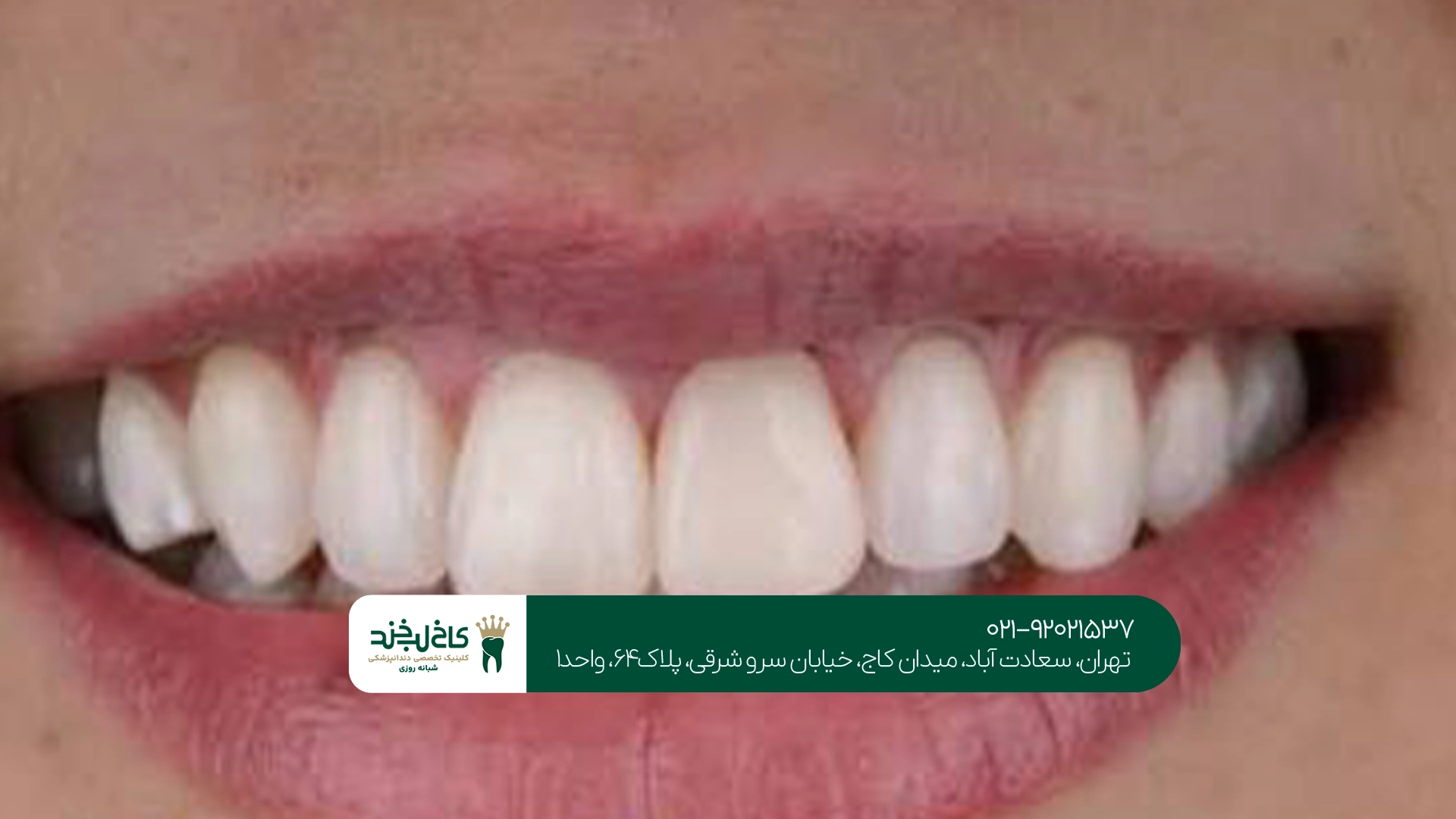 کامپوزیت دندان در تهران کامپوزیت دندان در تهران