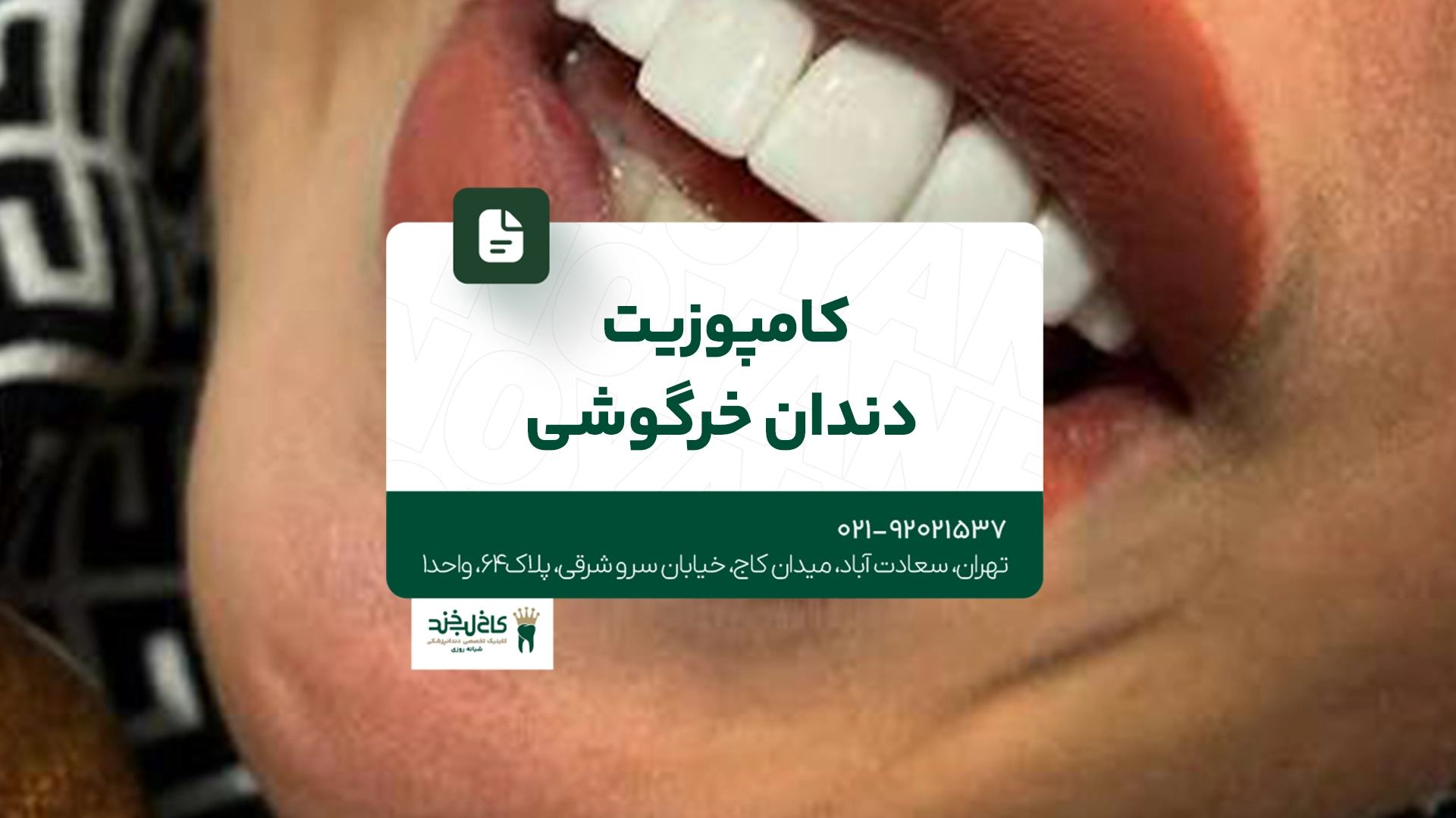 کامپوزیت دندان خرگوشی کامپوزیت دندان خرگوشی