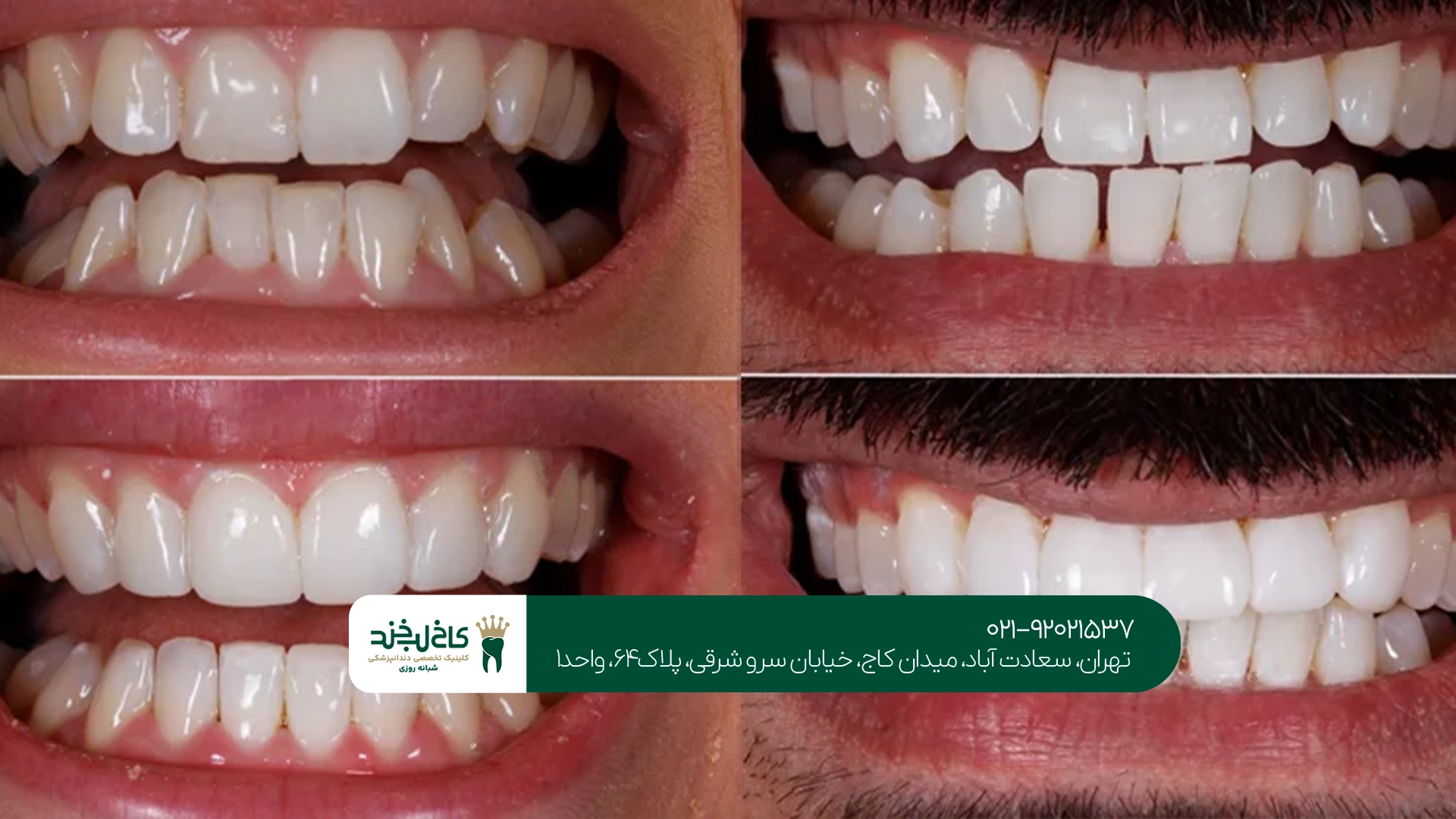 چه افرادی کاندیدای مناسب کامپوزیت دندان هستند؟
