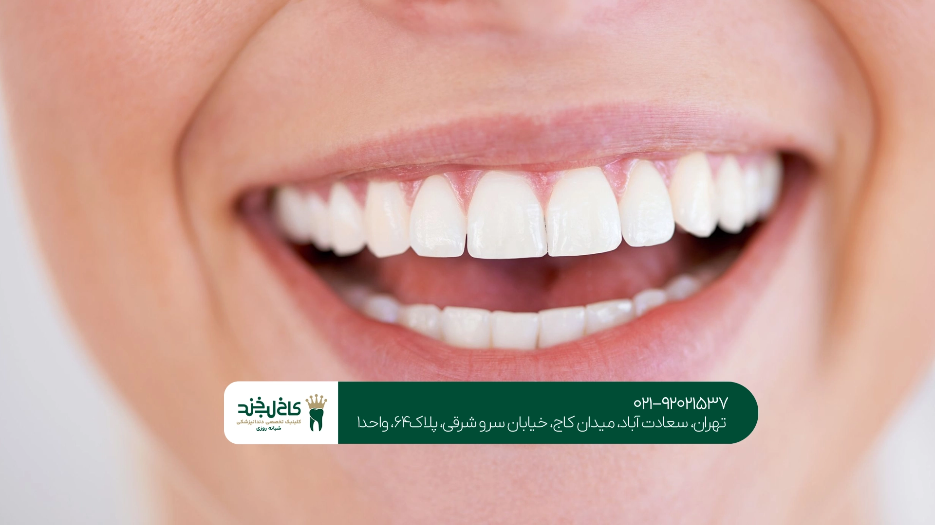 کامپوزیت دندان سعادت آباد