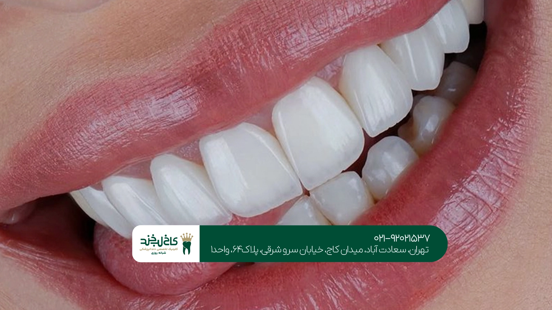 ماندگاری کامپوزیت دندان
