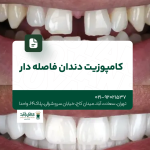 کامپوزیت دندان فاصله دار