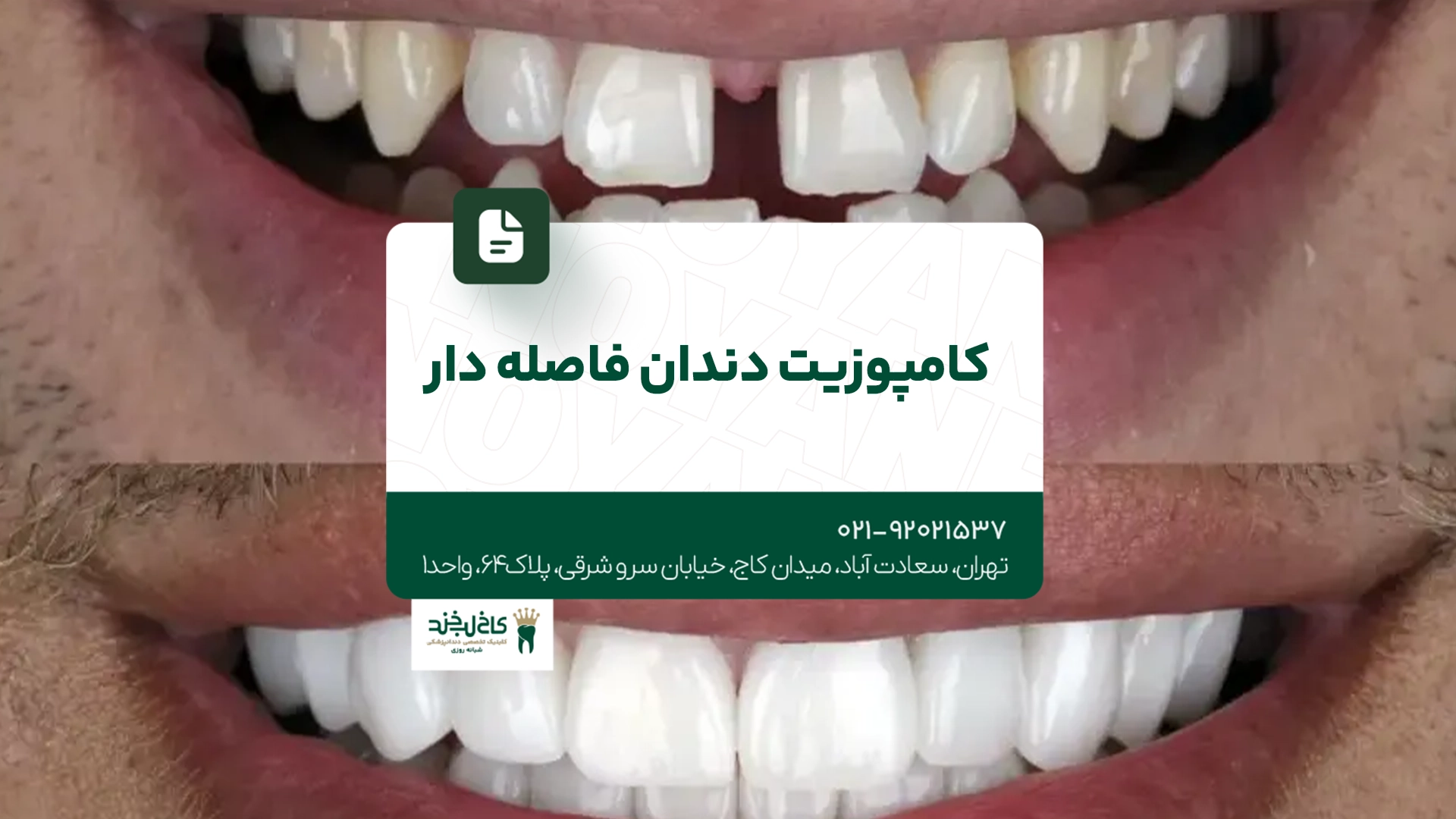 کامپوزیت دندان فاصله دار کامپوزیت دندان فاصله دار