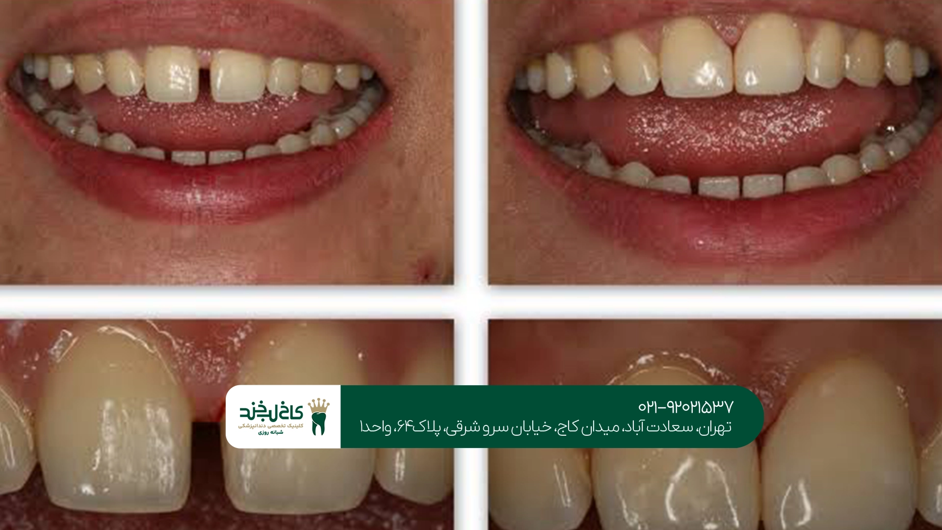 کامپوزیت دندان کامپوزیت دندان