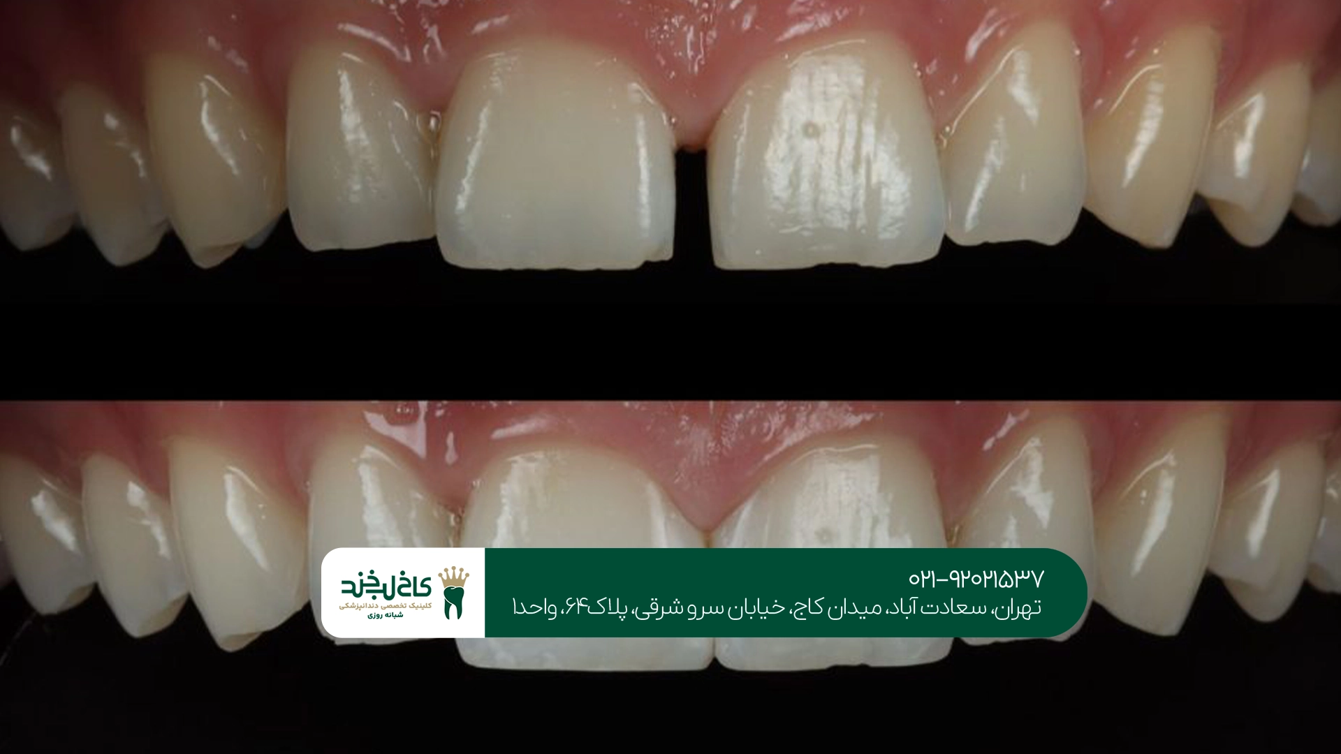 بهترین مرکز کامپوزیت دندان فاصلهدار بهترین مرکز کامپوزیت دندان فاصلهدار