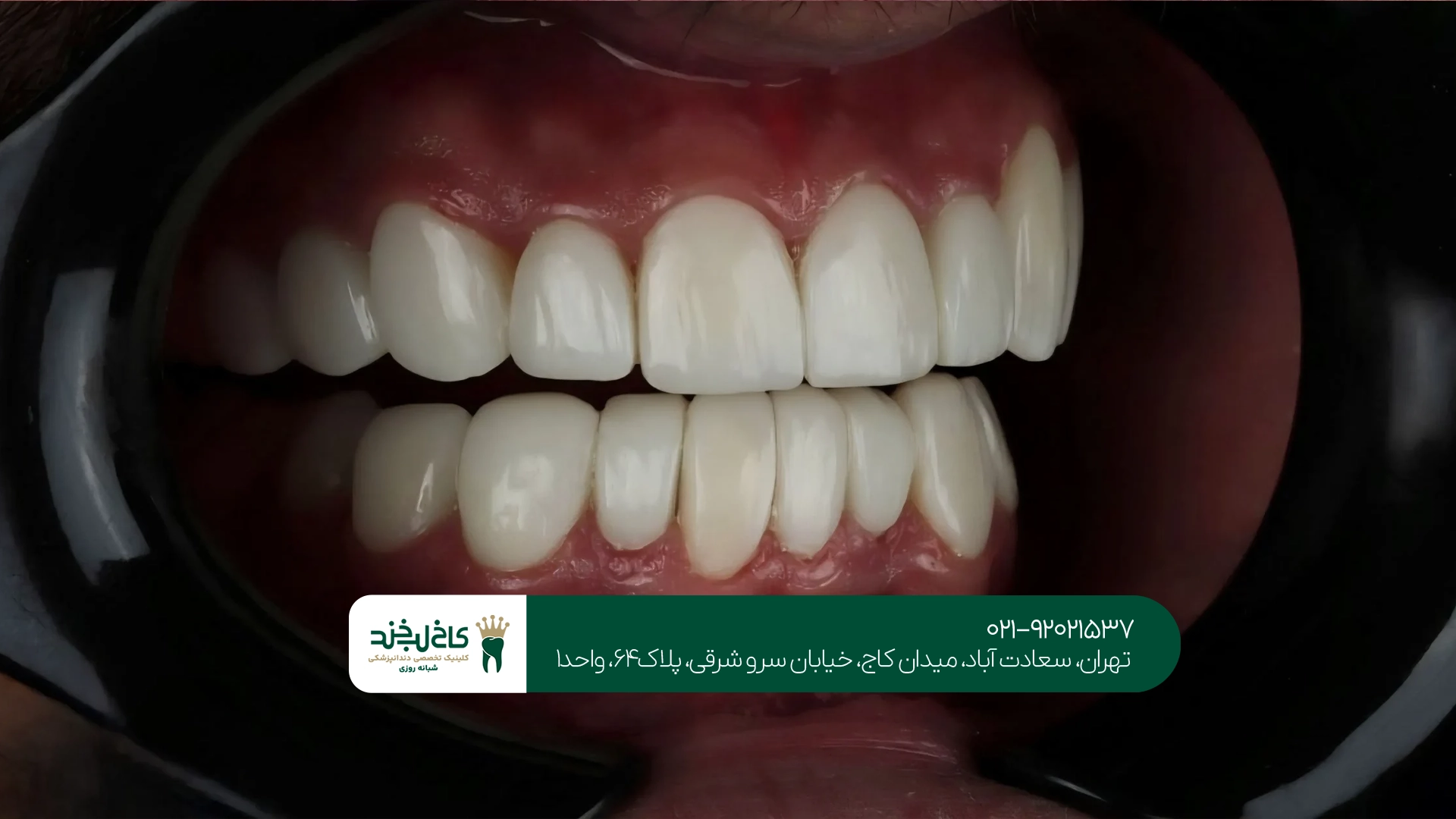 کاربردهای کامپوزیت دندان کاربردهای کامپوزیت دندان