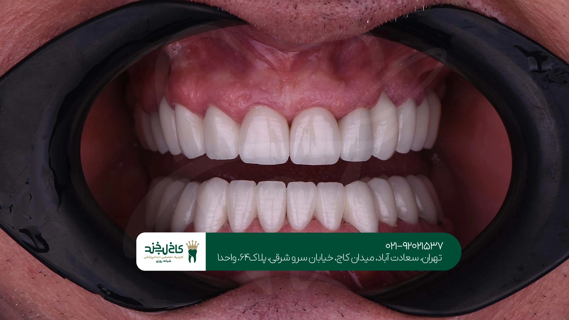 مهمترین مزایای کامپوزیت دندان مهمترین مزایای کامپوزیت دندان