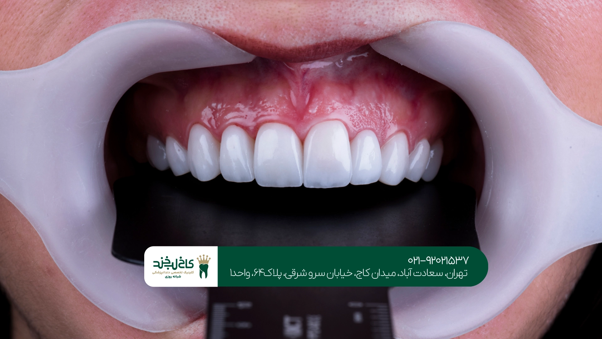 انواع کامپوزیت دندان انواع کامپوزیت دندان