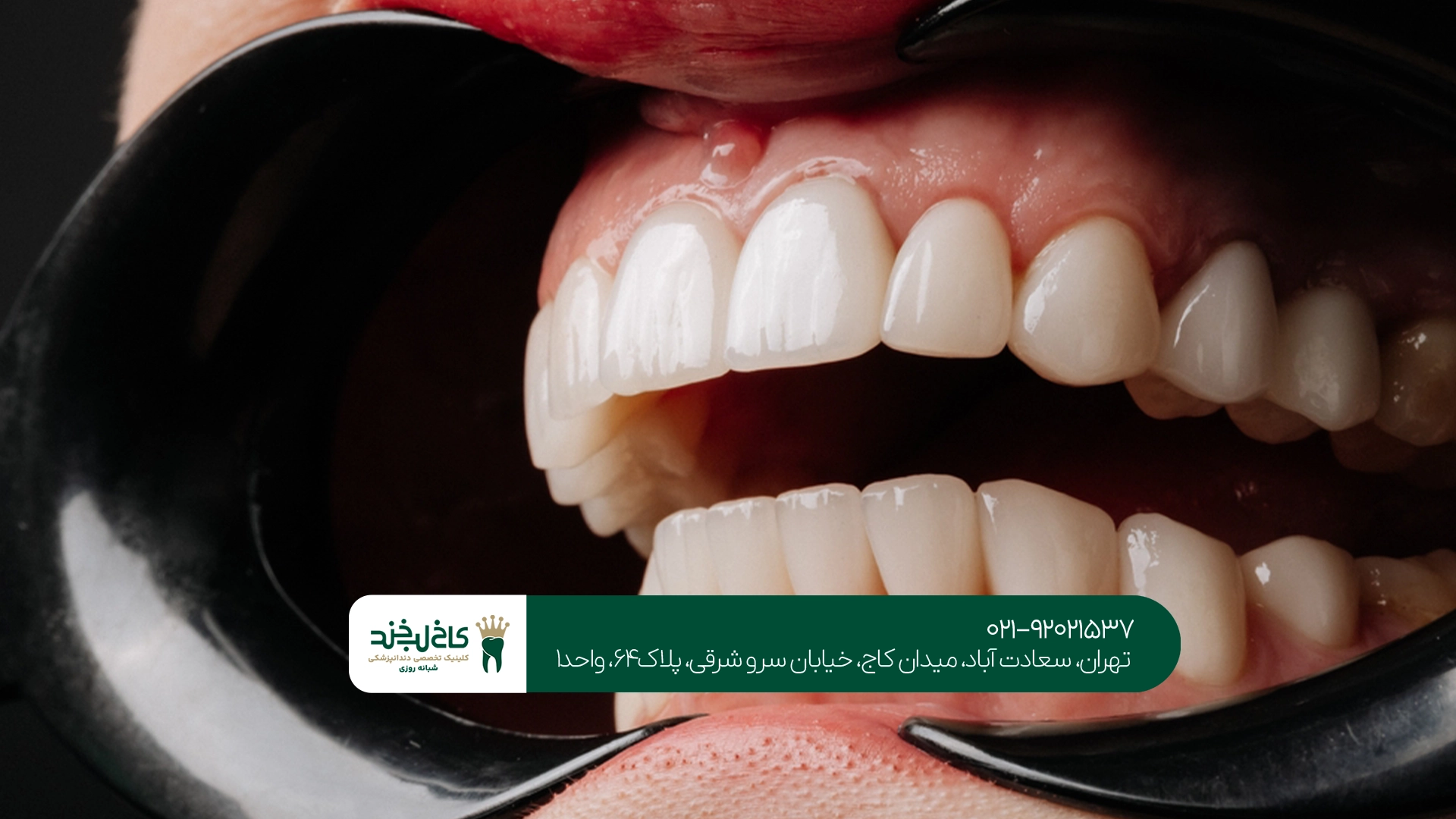 کامپوزیت دندان چیست؟ کامپوزیت دندان چیست؟