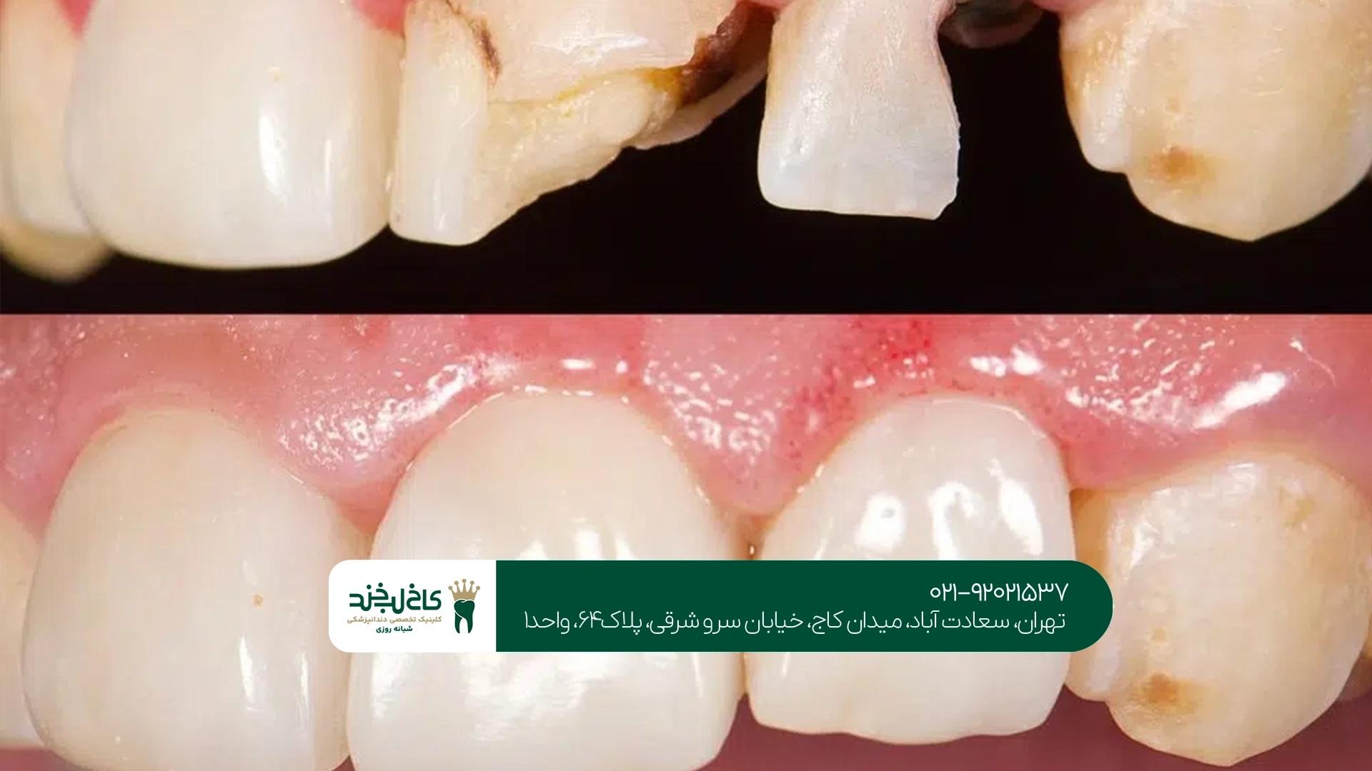 مراقبتهای بعد از کامپوزیت دیجیتال مراقبتهای بعد از کامپوزیت دیجیتال