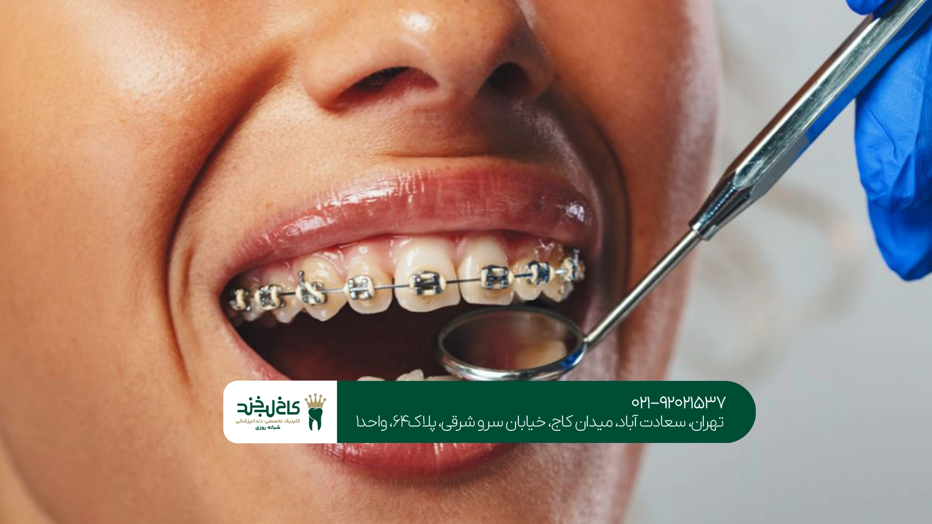هزینه ارتودنسی ثابت به چه عواملی بستگی دارد؟