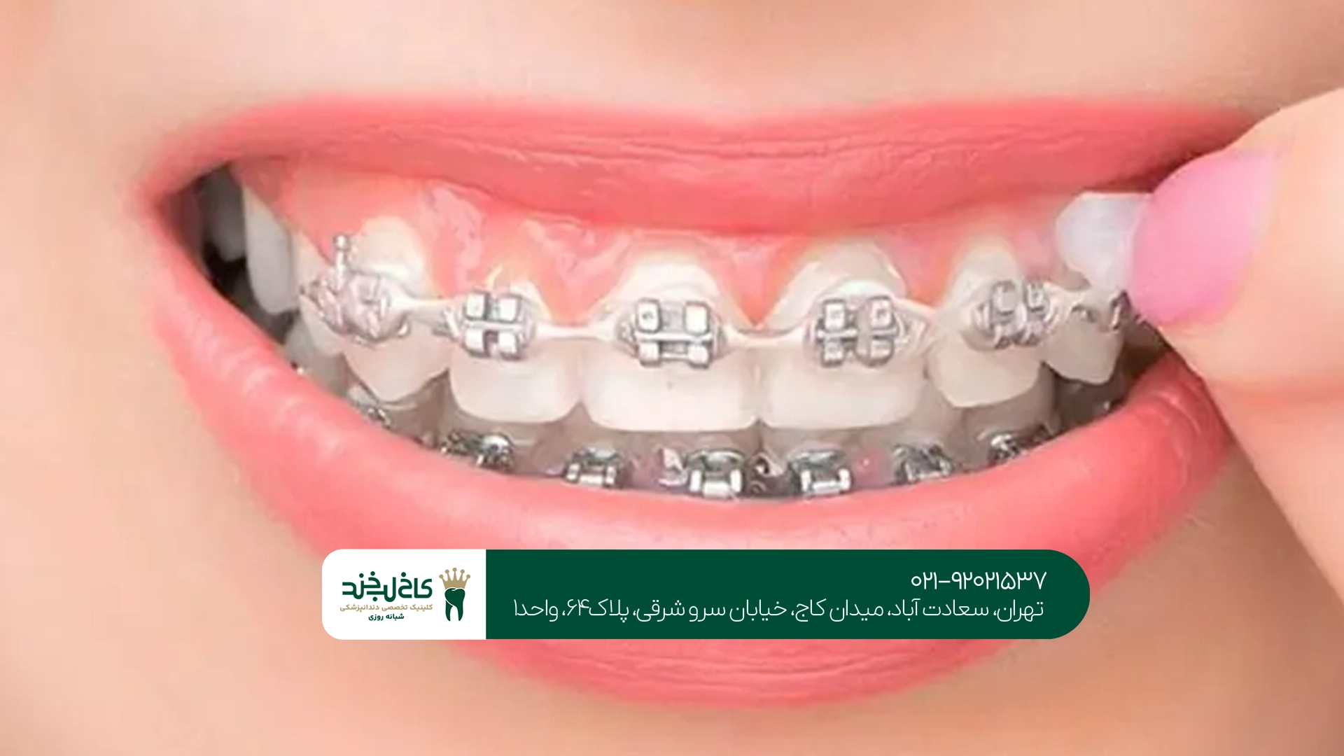 مراقبتهای لازم بعد از نصب ارتودنسی ثابت