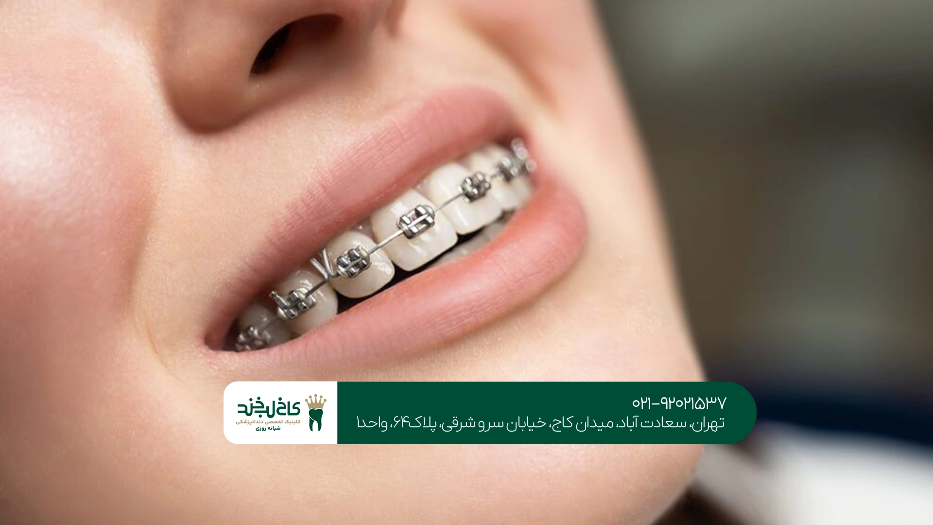 ارتودنسی دندان در کاخ لبخند ارتودنسی دندان در کاخ لبخند