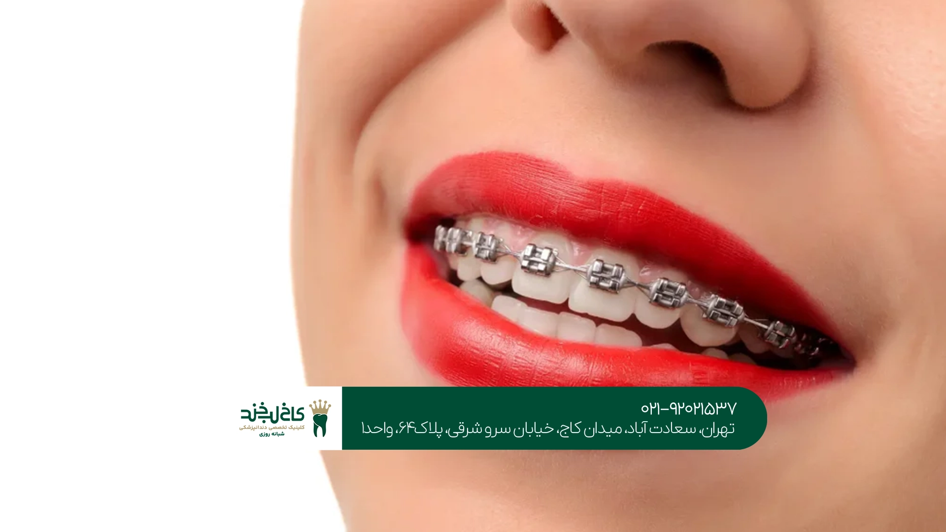 انواع ارتودنسی دندان در کاخ لبخند انواع ارتودنسی دندان در کاخ لبخند