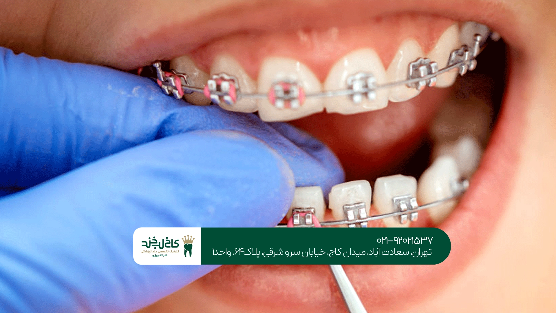 مدت زمان درمان ارتودنسی چقدر است؟ مدت زمان درمان ارتودنسی چقدر است؟