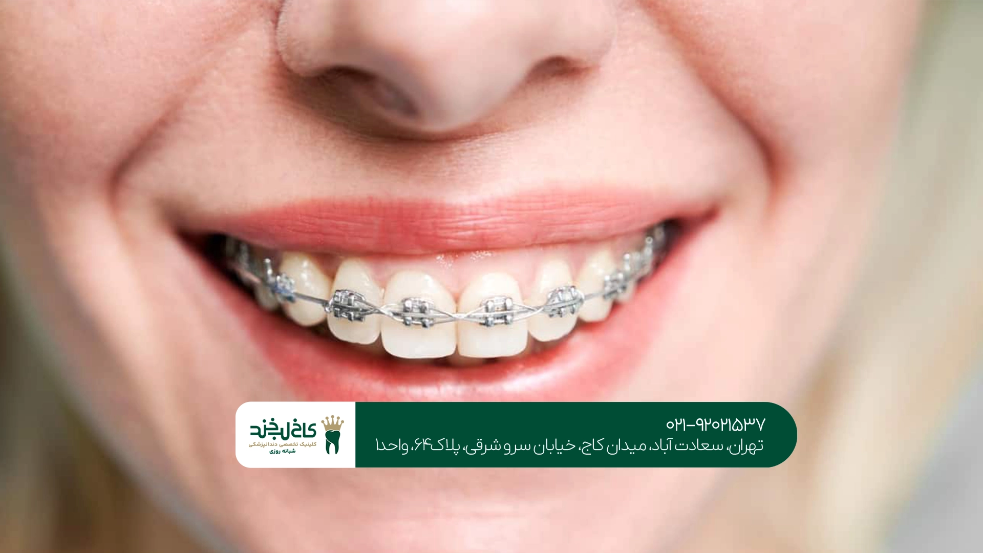 ارتودنسی بهتر است یا لمینت و کامپوزیت دندان؟ ارتودنسی بهتر است یا لمینت و کامپوزیت دندان؟