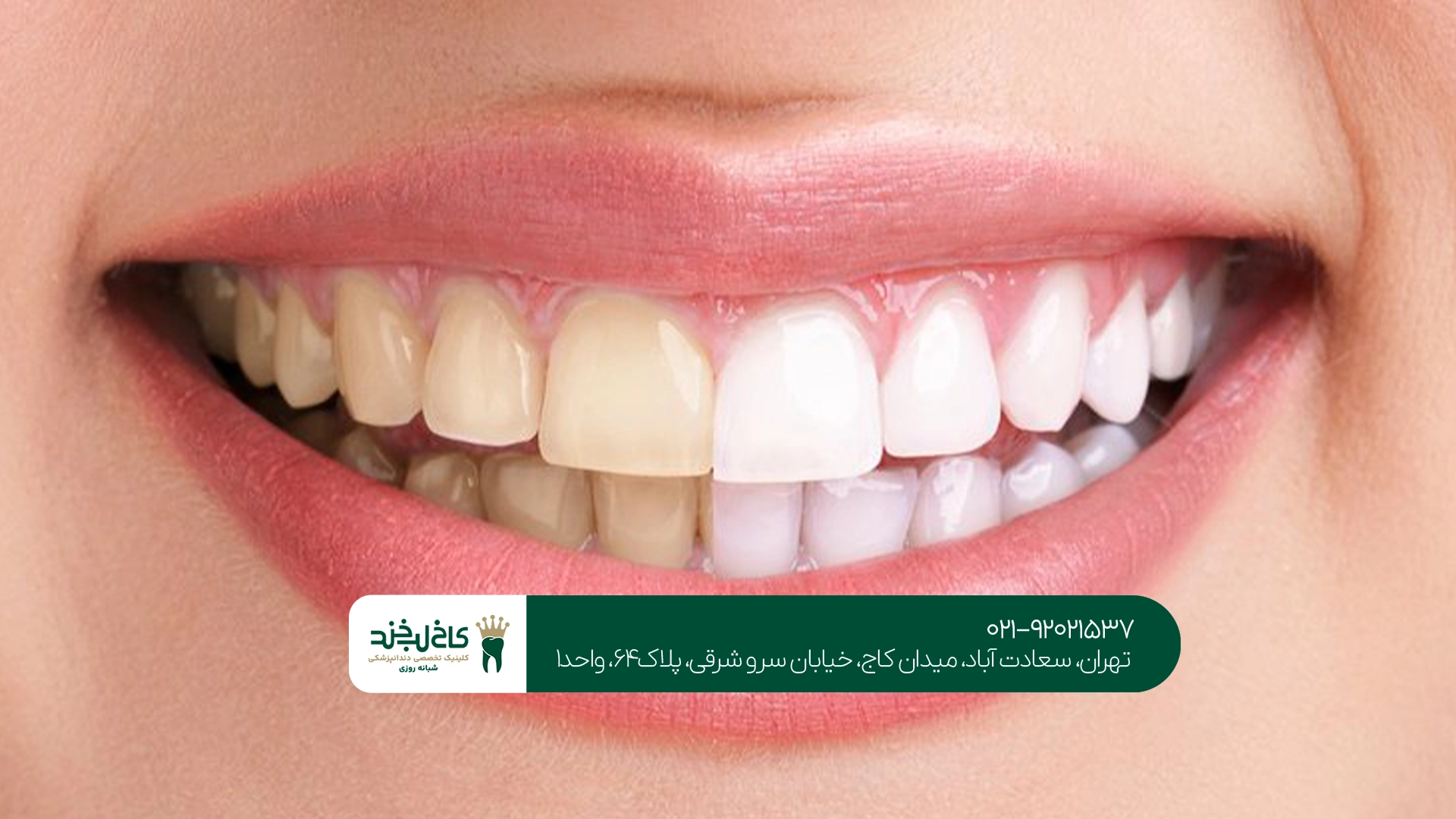اصلاح رنگ دندان با کامپوزیت اصلاح رنگ دندان با کامپوزیت