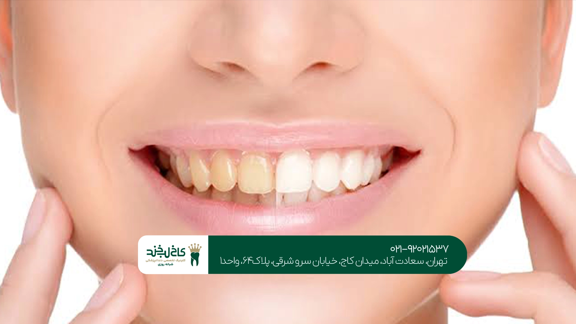 اصلاح رنگ دندان در تهران اصلاح رنگ دندان در تهران