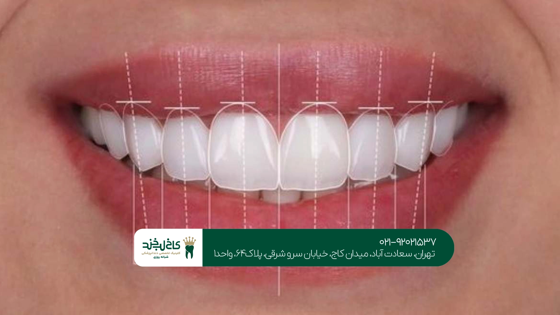 بهترین مرکز اصلاح طرح لبخند بهترین مرکز اصلاح طرح لبخند