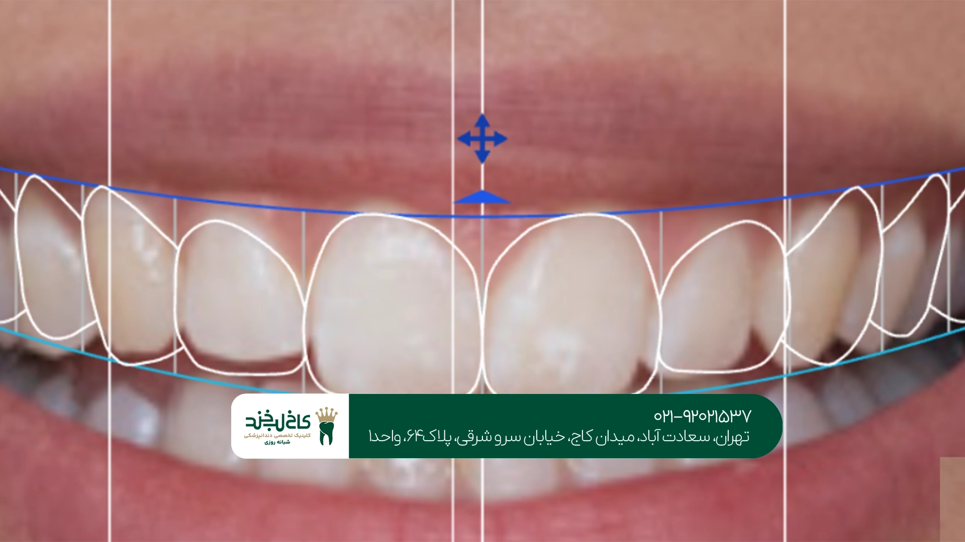 روشهای اصلاح طرح لبخند روشهای اصلاح طرح لبخند