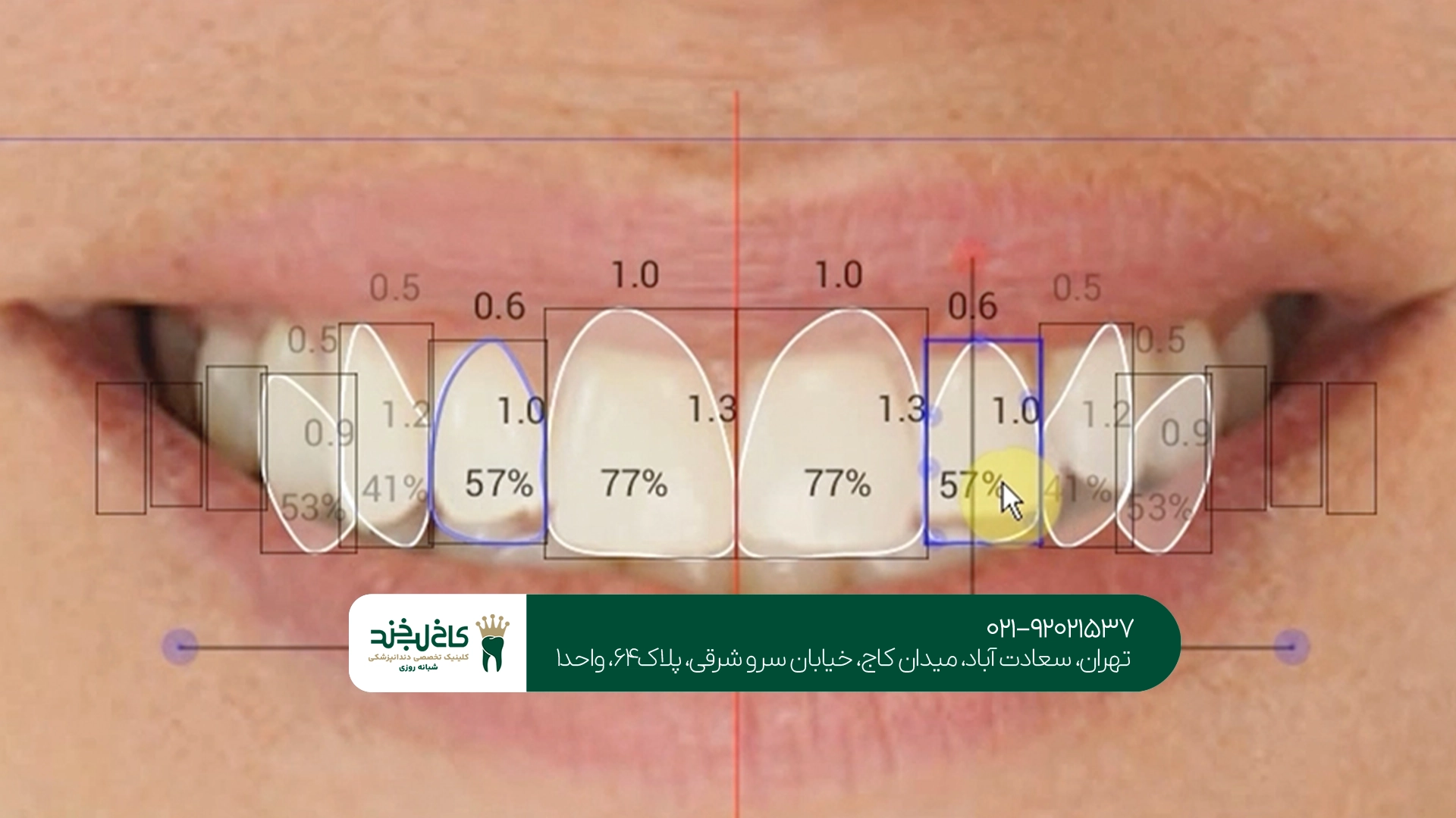 مراحل اصلاح طرح لبخند مراحل اصلاح طرح لبخند