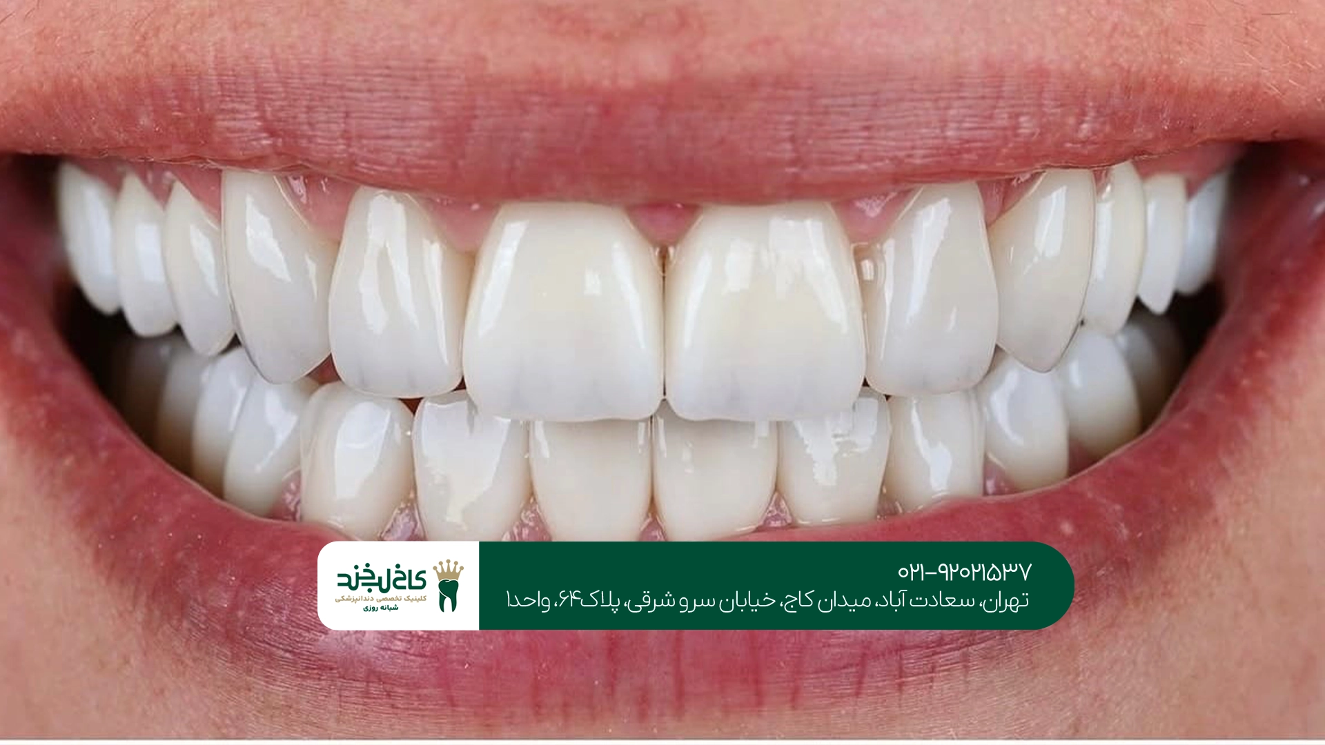 بهترین مرکز اصلاح فاصله دندان بهترین مرکز اصلاح فاصله دندان