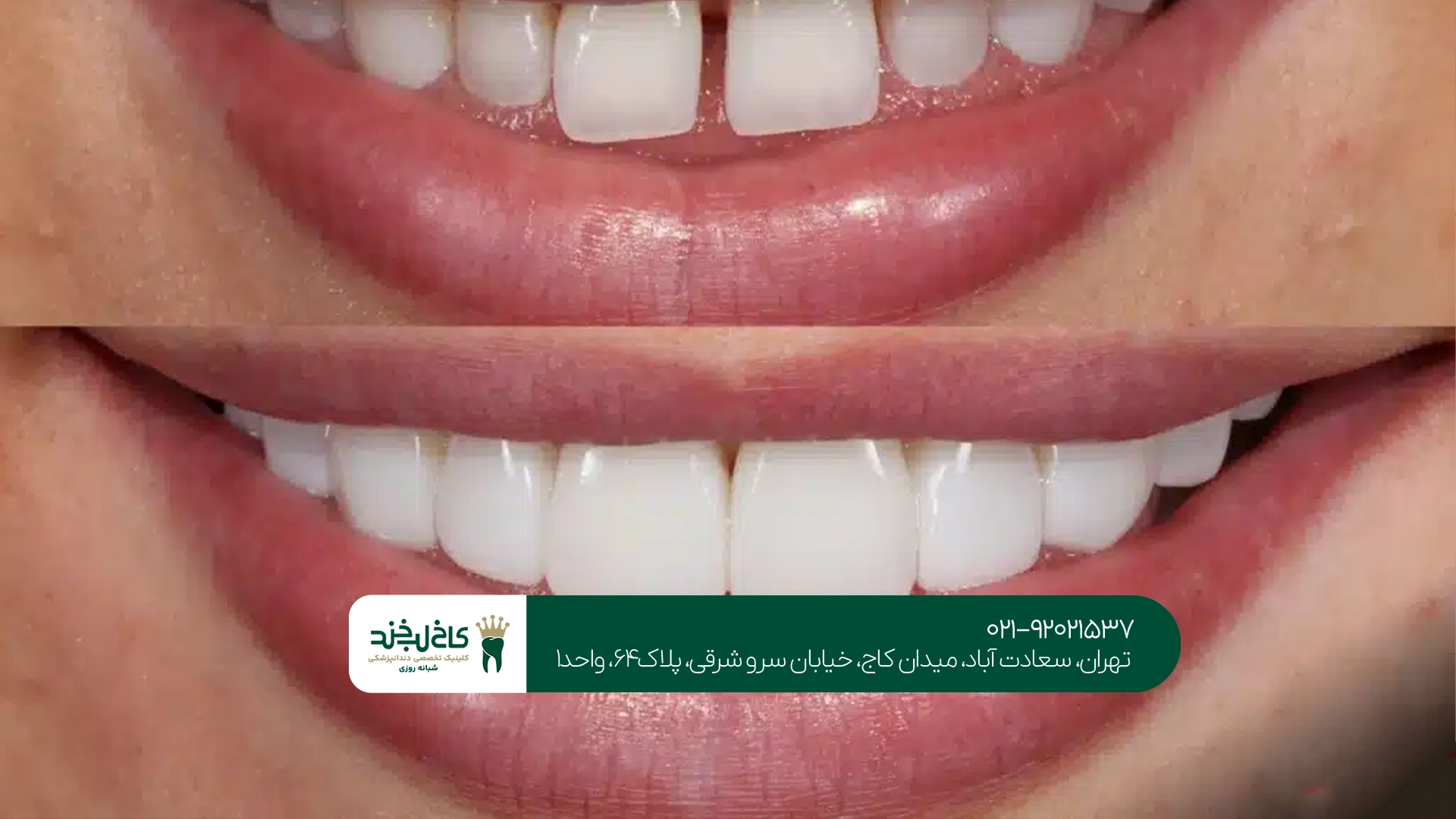 اصلاح فاصله دندان با کامپوزیت اصلاح فاصله دندان با کامپوزیت