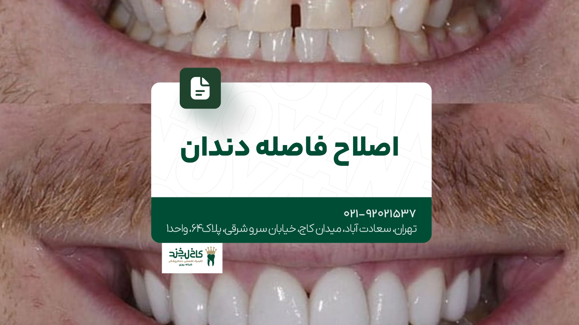 اصلاح فاصله دندان اصلاح فاصله دندان