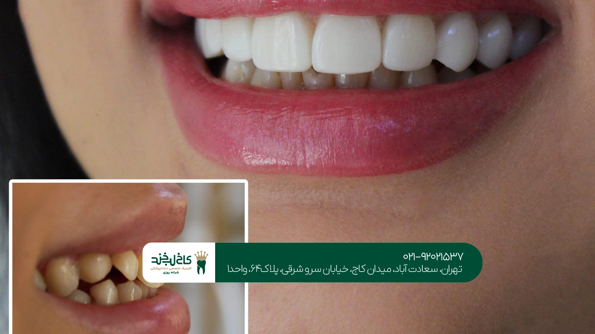 اصلاح فرم دندانهای نامتقارن