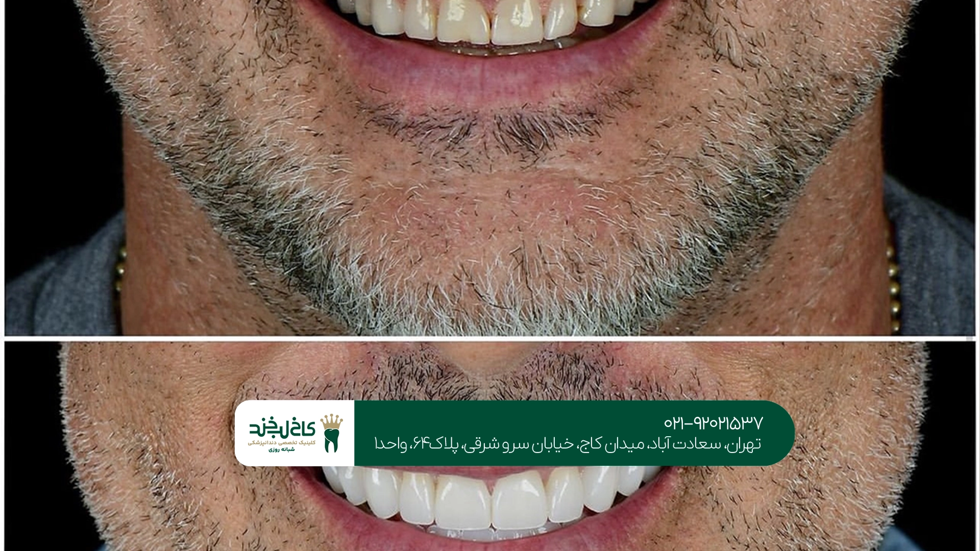 اصلاح فرم دندان با لمینت