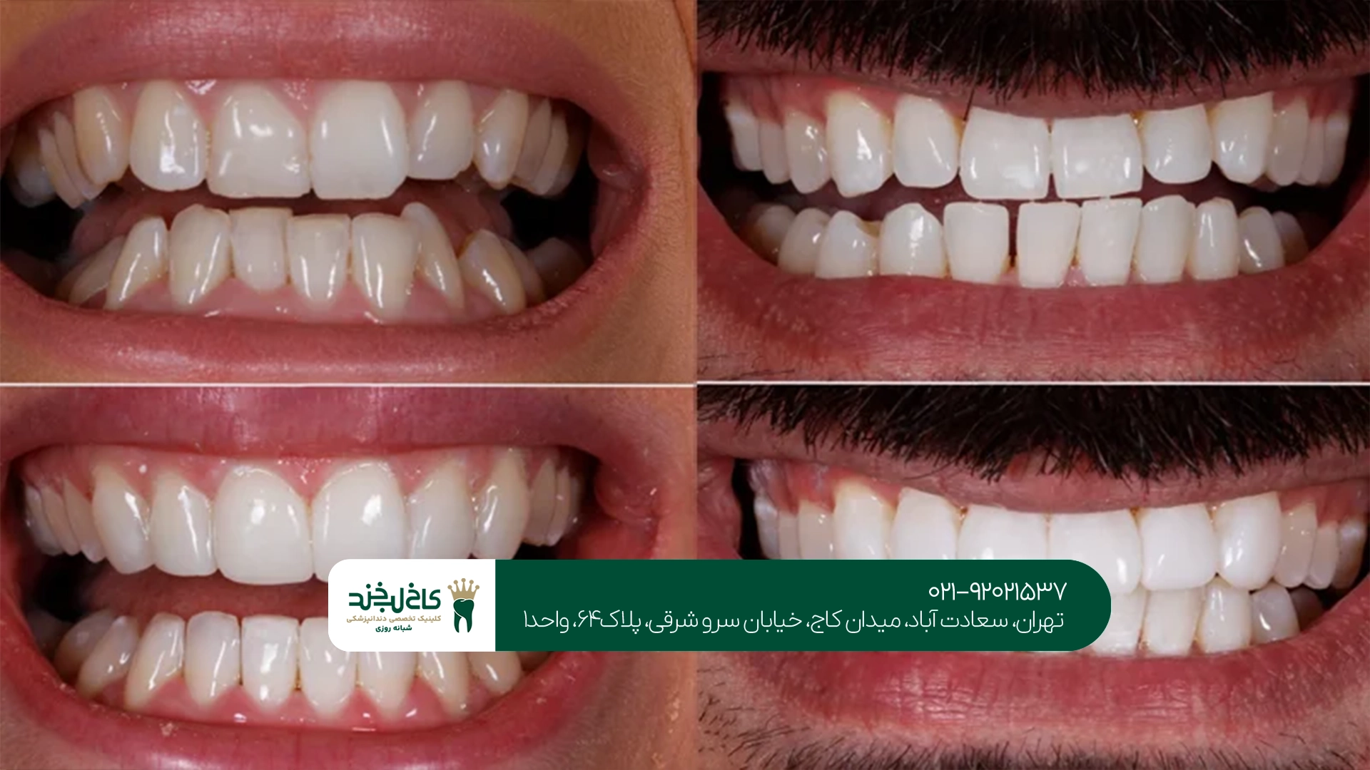 روشهای اصلاح فرم دندان