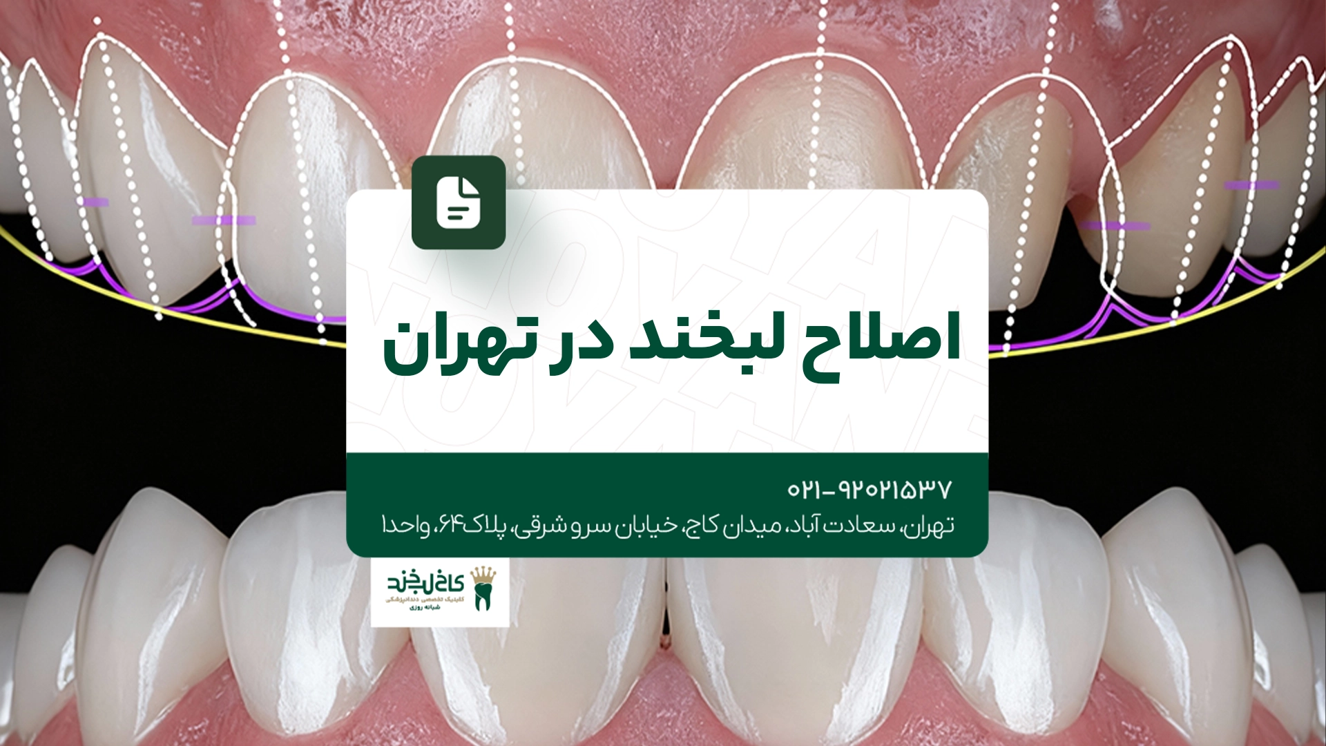 اصلاح لبخند در تهران