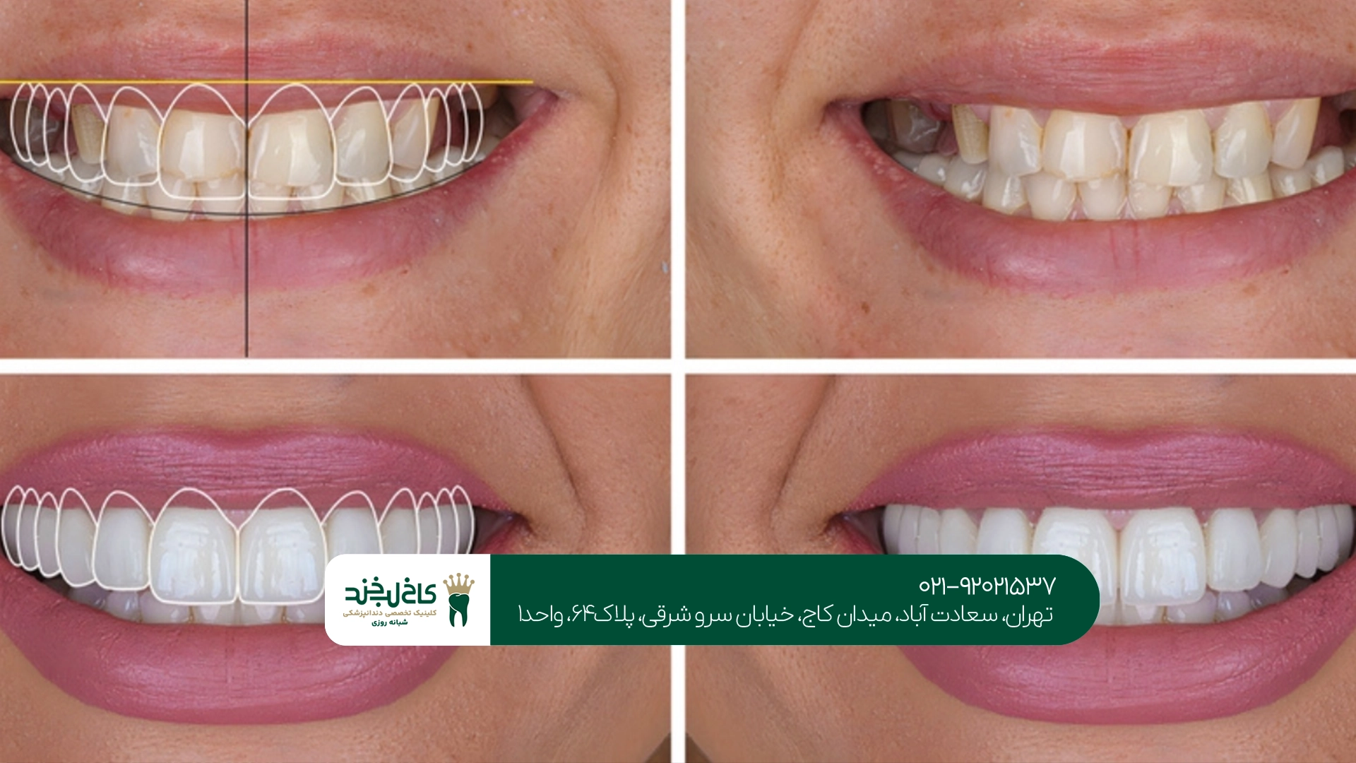اصلاح لبخند با لمینت در تهران