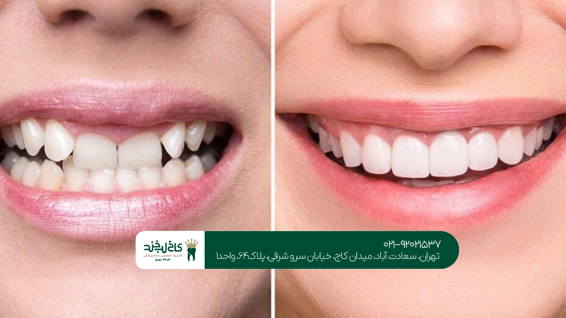 اصلاح لبخند با کامپوزیت در تهران چگونه انجام میشود؟