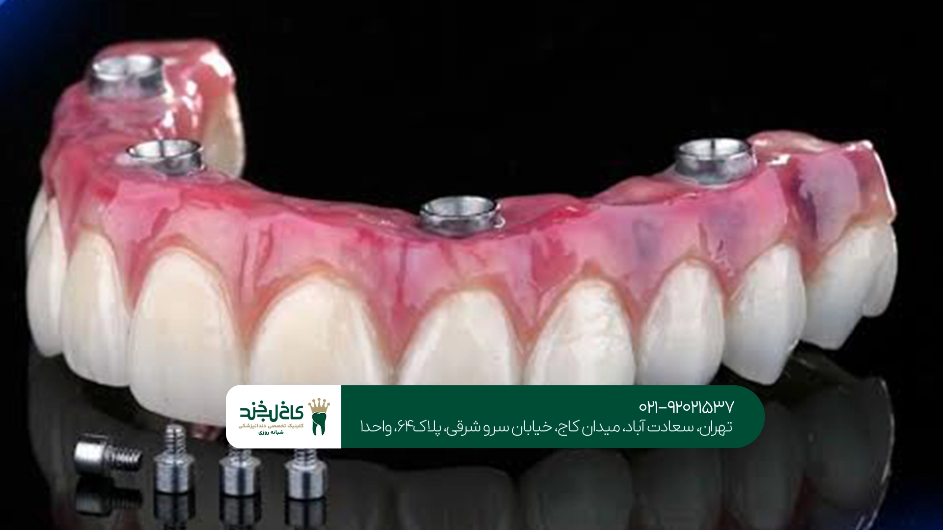 اوردنچر روی ایمپلنت در تهران اوردنچر روی ایمپلنت در تهران