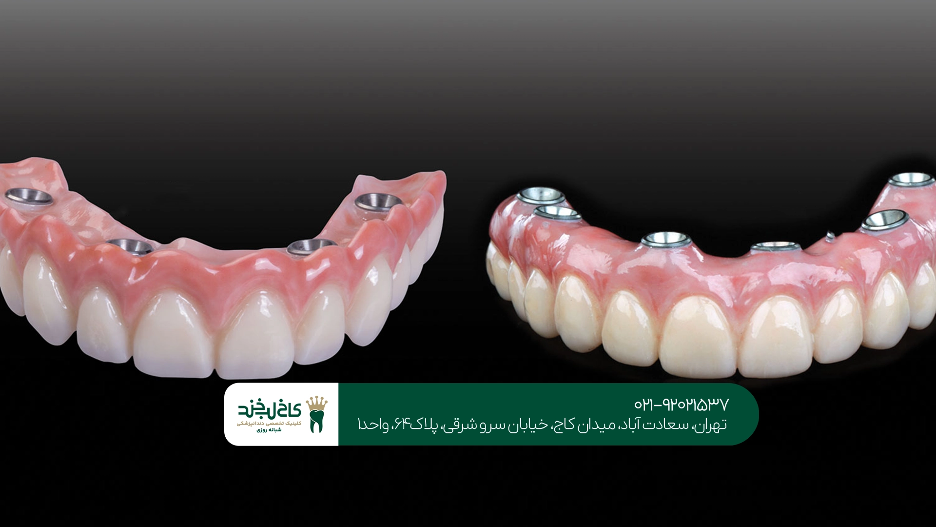 قیمت اوردنچر روی ایمپلنت قیمت اوردنچر روی ایمپلنت