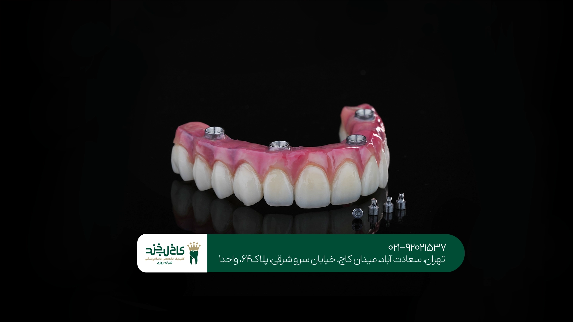 مزایای اوردنچر روی ایمپلنت مزایای اوردنچر روی ایمپلنت