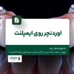 اوردنچر روی ایمپلنت