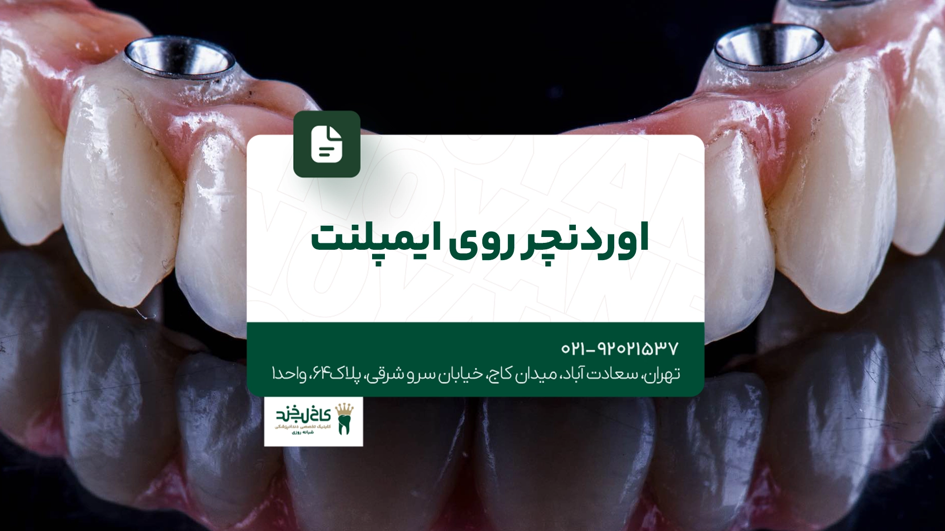 اوردنچر روی ایمپلنت اوردنچر روی ایمپلنت