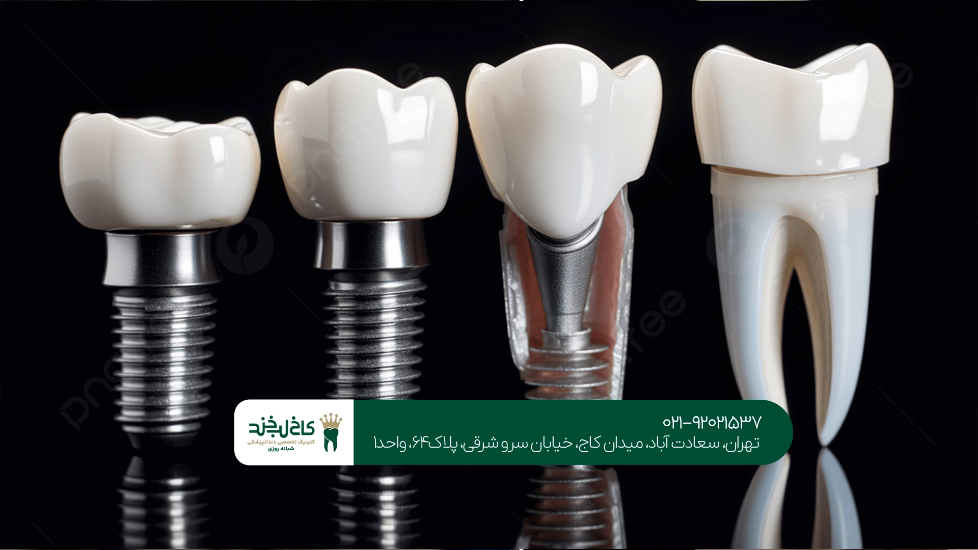 مناسبترین شرایط برای استفاده از ایمپلنت SIC