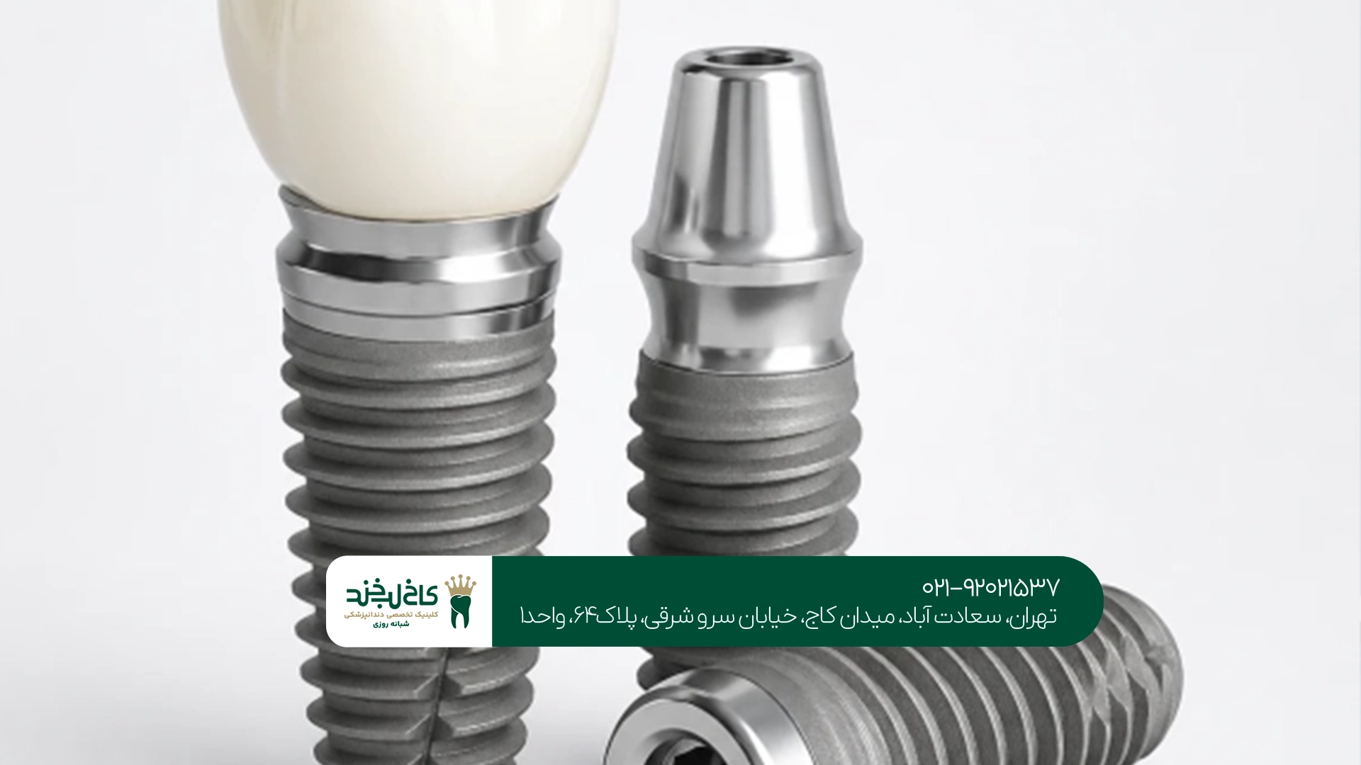 ایمپلنت آمریکایی چقدر ماندگاری دارد؟