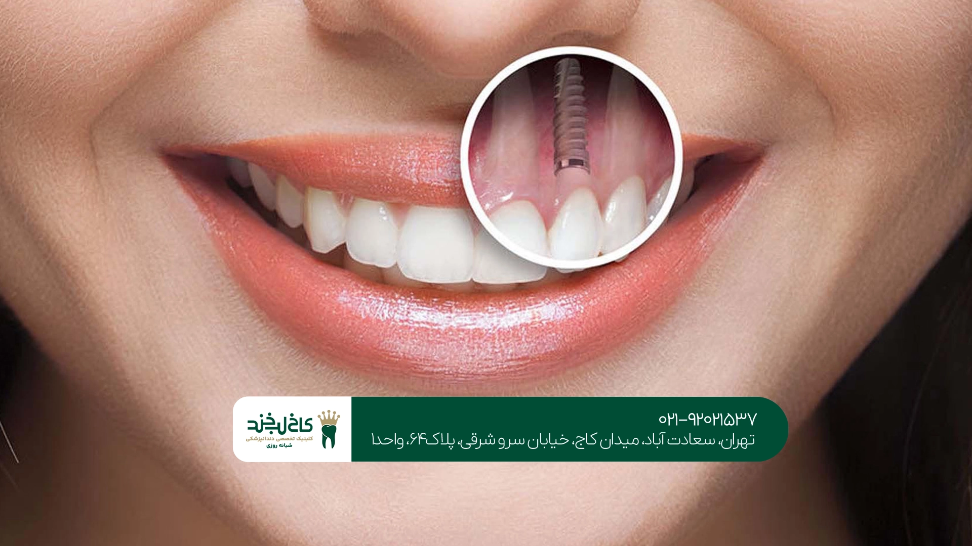 بهترین مرکز ایمپلنت ارزان تهران