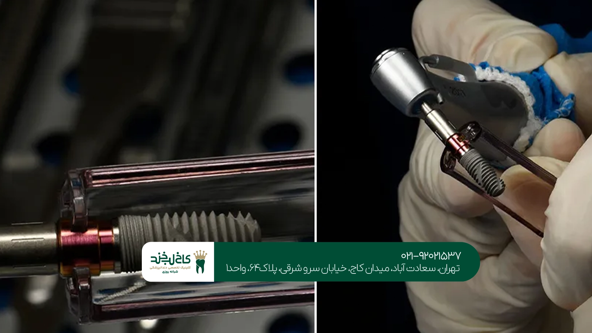 کلینیک تخصصی ایمپلنت اشترومن در تهران