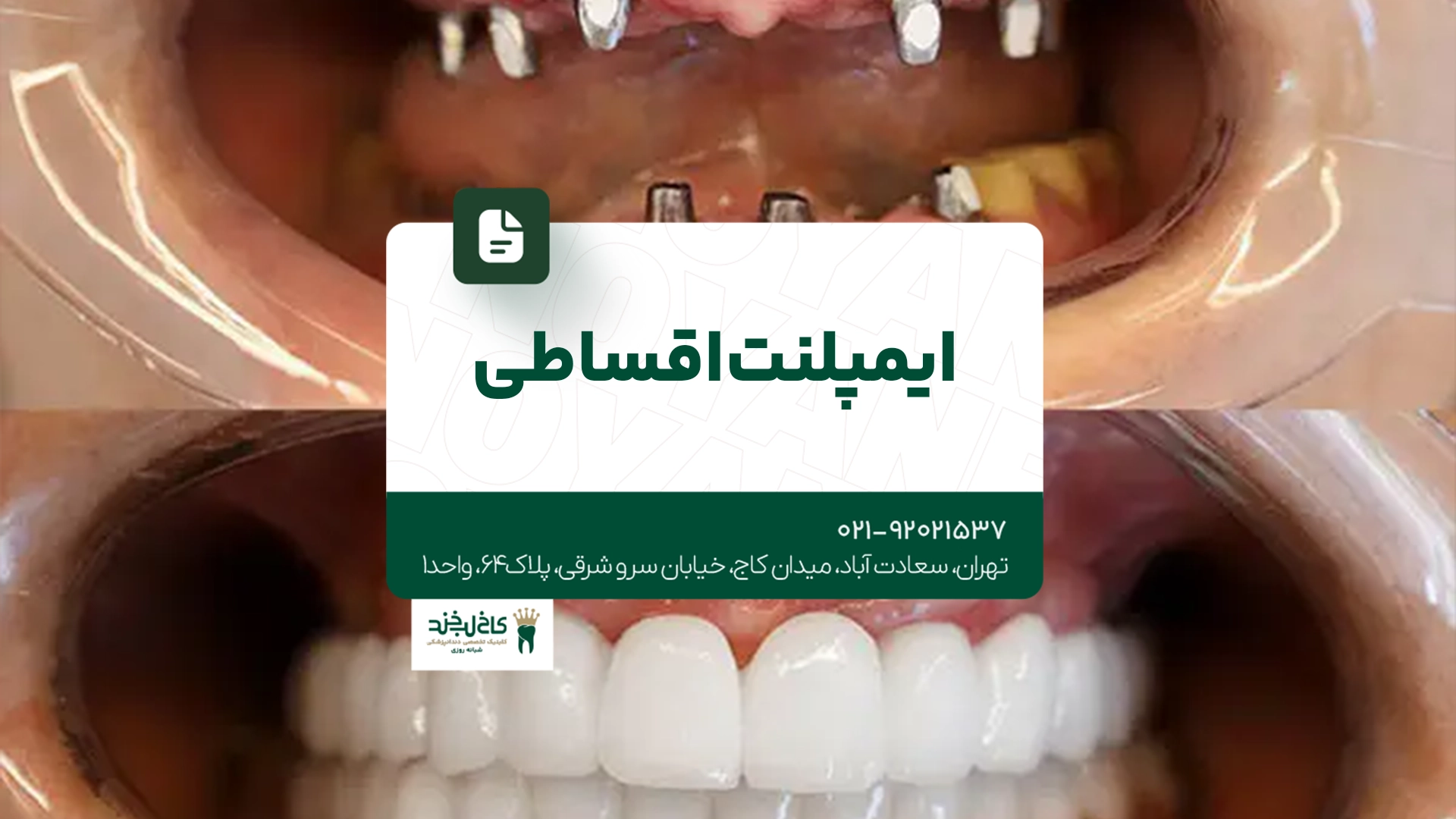 ایمپلنت اقساطی تهران
