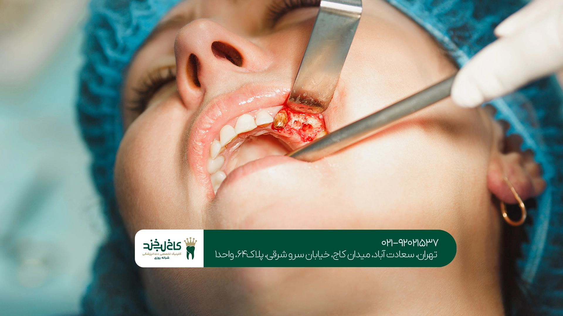 مراحل ایمپلنت اقساطی تهران